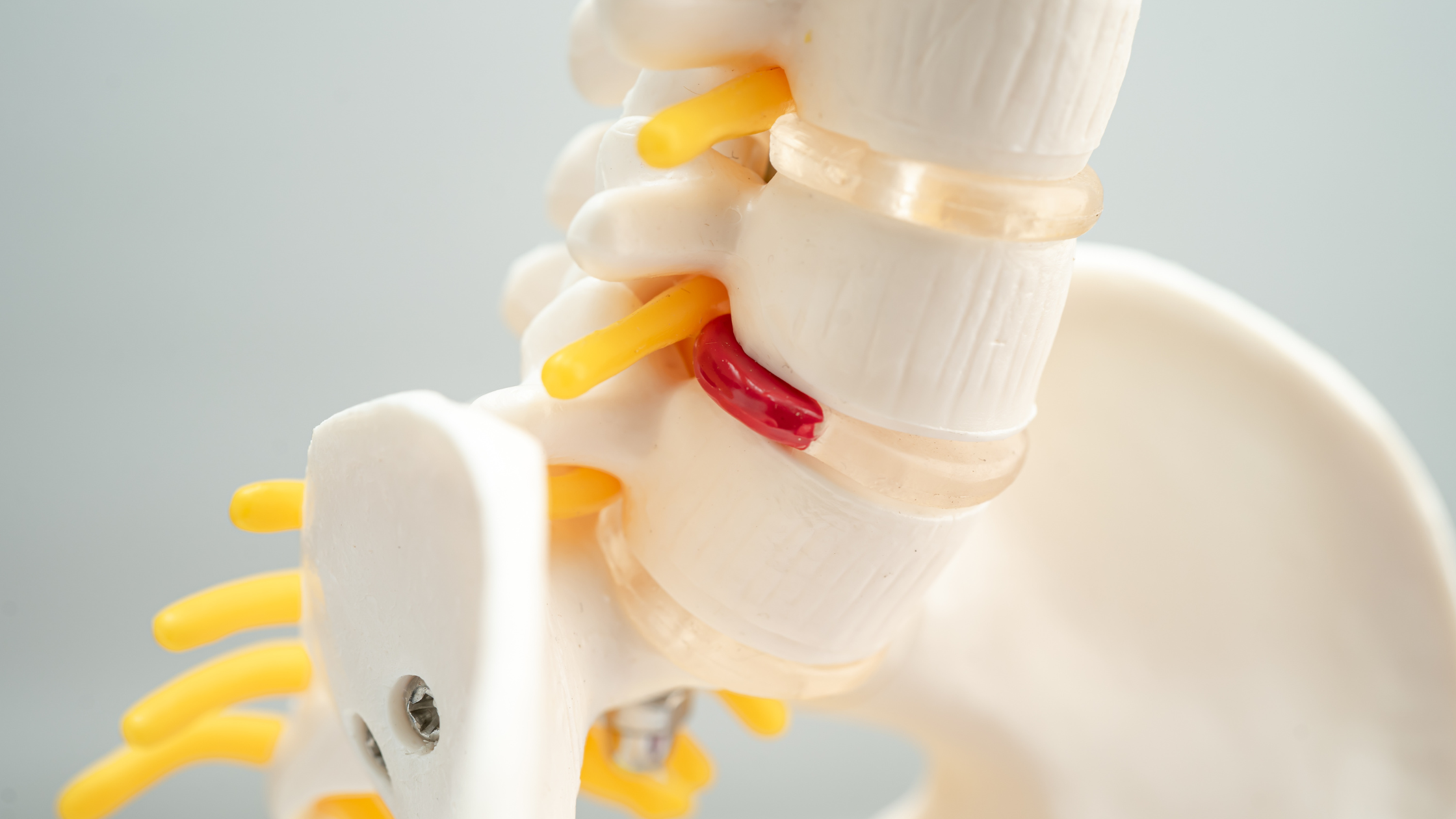 degenerative disc disease