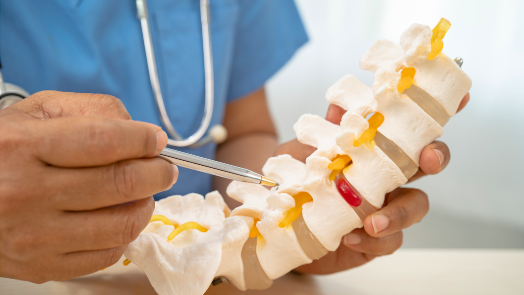 a doctor holding a model of a spine, pointing to a herniated disc